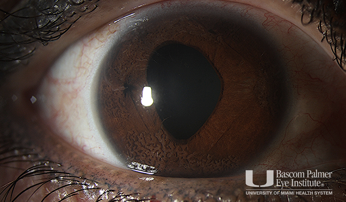 IE080222OI Iridocorneal Endothelial (ICE) Syndrome, CoganReese/Iris
